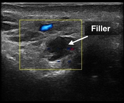 Ultrasound image