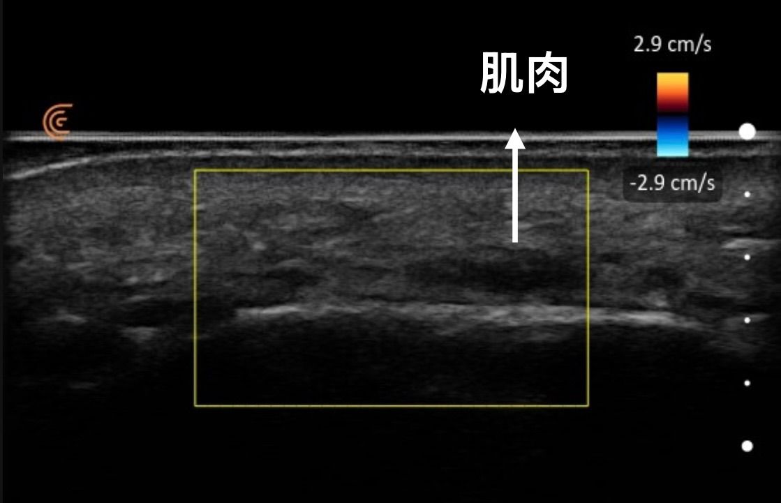 超音波影像